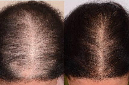 Rosemary Hydrolyzed Keratin Shampoo (BUY 1 GET 1 FREE)